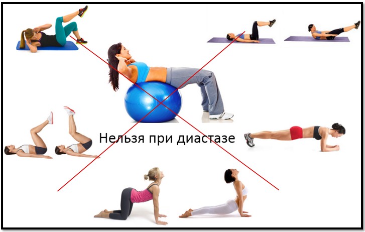 Запрещенные при диастазе упражнения