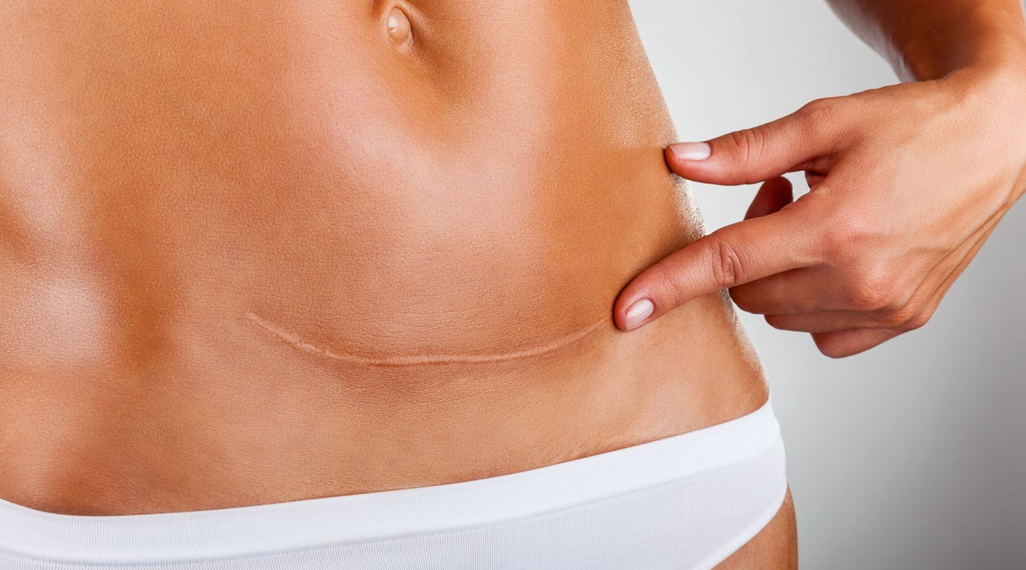 Живот после кесарева сечения