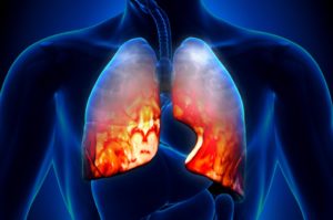 Разновидности атипичной пневмонии Разновидности атипичной пневмонии