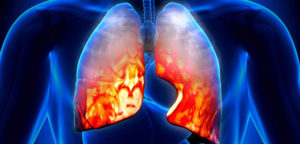 Как лечится двустороннее воспаление легких у детей и пожилых Как лечится двустороннее воспаление легких у детей и пожилых