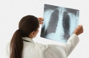 Симптомы и лечение казеозной пневмонии Симптомы и лечение казеозной пневмонии