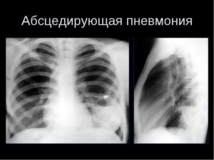 Абсцедирующая пневмония Абсцедирующая пневмония