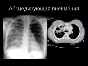 Абсцедирующая пневмония Абсцедирующая пневмония
