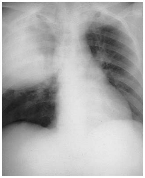 Внутрибольничная пневмония Внутрибольничная пневмония