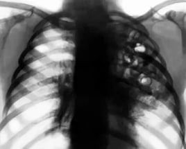 Внутрибольничная пневмония Внутрибольничная пневмония