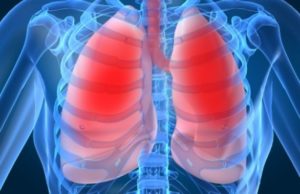 пневмония пневмония