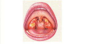 Воспаление задней стенки горла Воспаление задней стенки горла