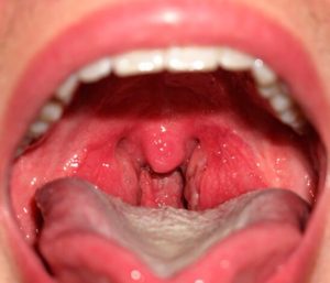 Воспаление задней стенки горла Воспаление задней стенки горла
